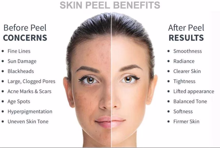 chemical peel