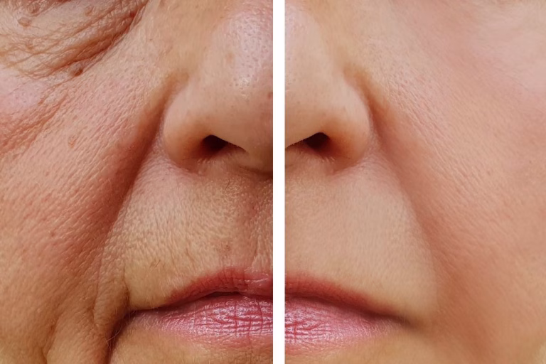 Skin Treatments For Wrinkles