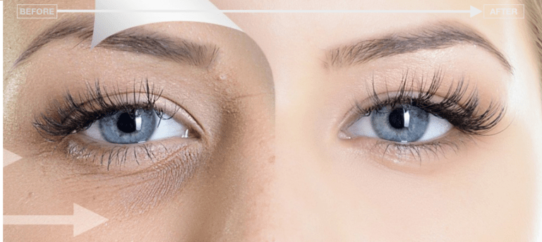 Best Dark Circle Treatments Under Eyes in Nepal